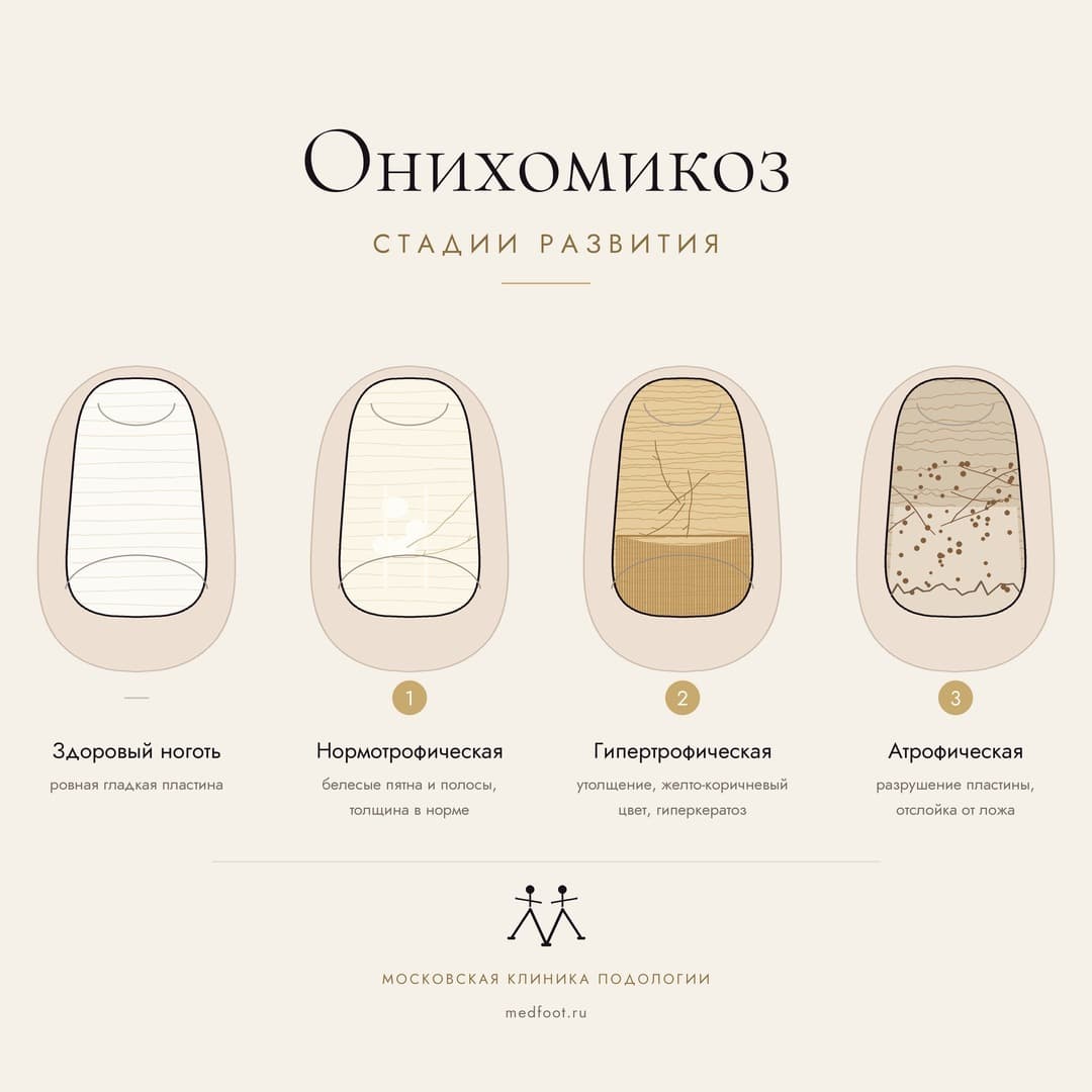 Онихомикоз: стадии развития и лечение грибка ногтей