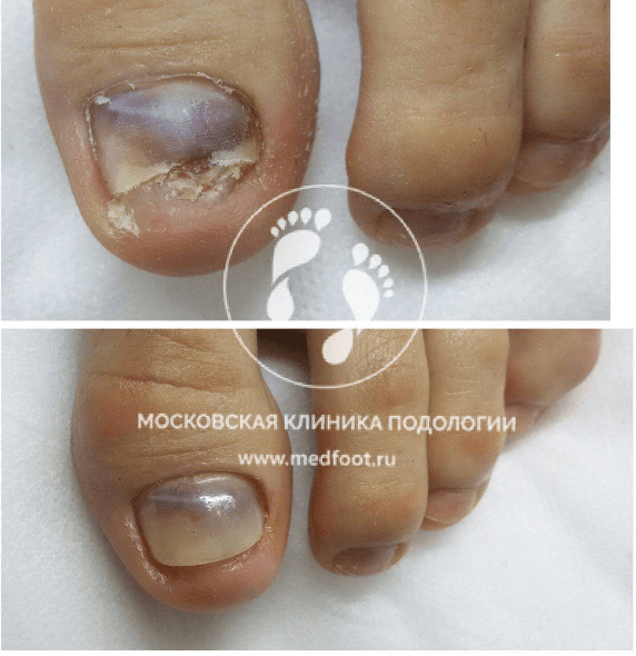 Гематома ногтя стопы — потемнение ногтевой пластины после травмы пальца ноги