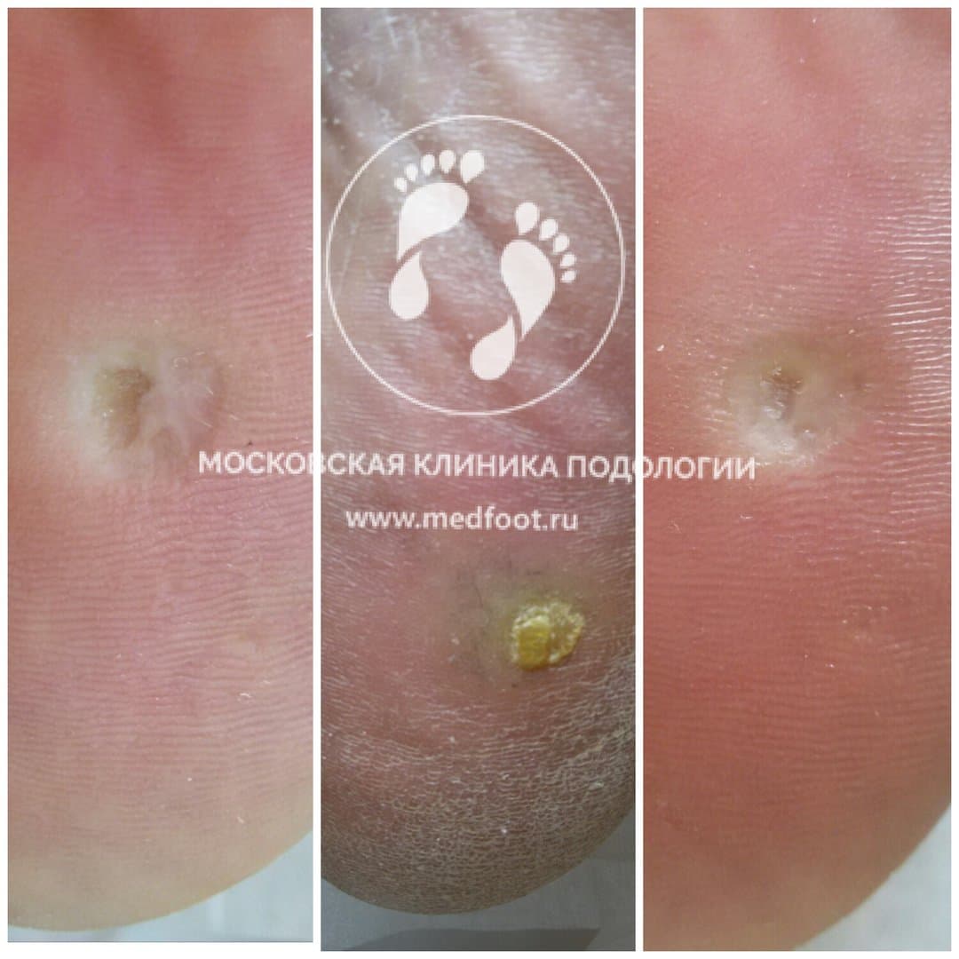 Лечение мозоли без хирургического вмешательства