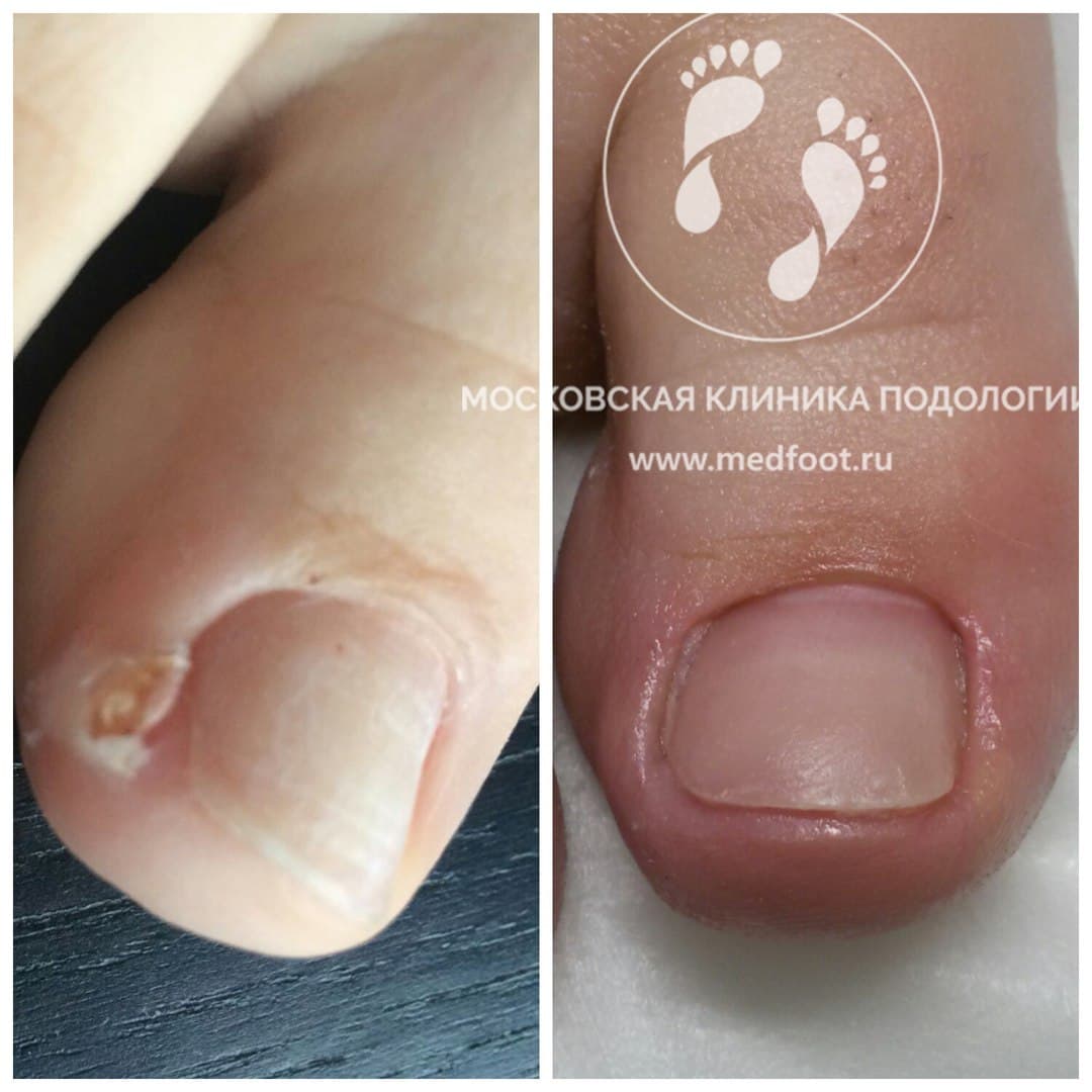 Вросший ноготь лечение