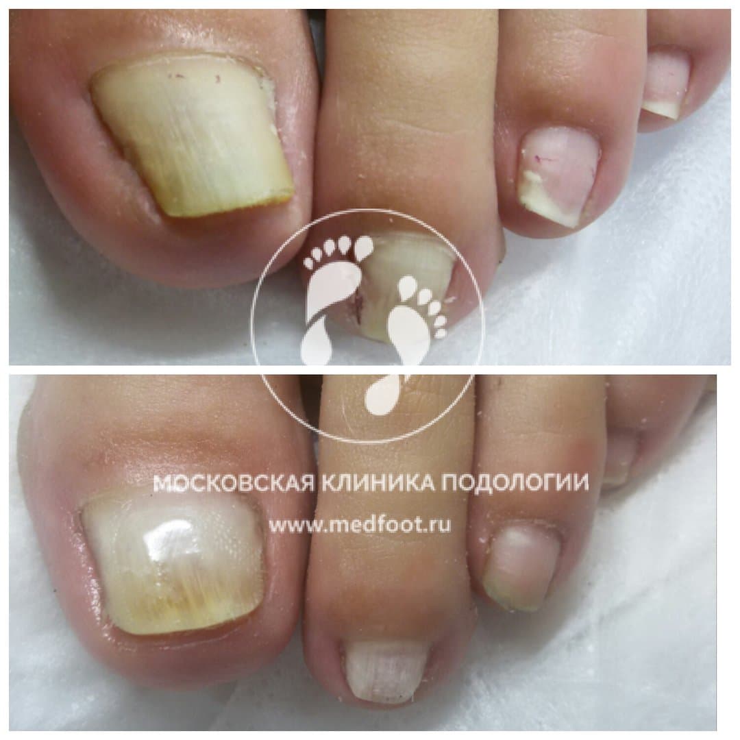 Деформация внутреннего свода стопы
