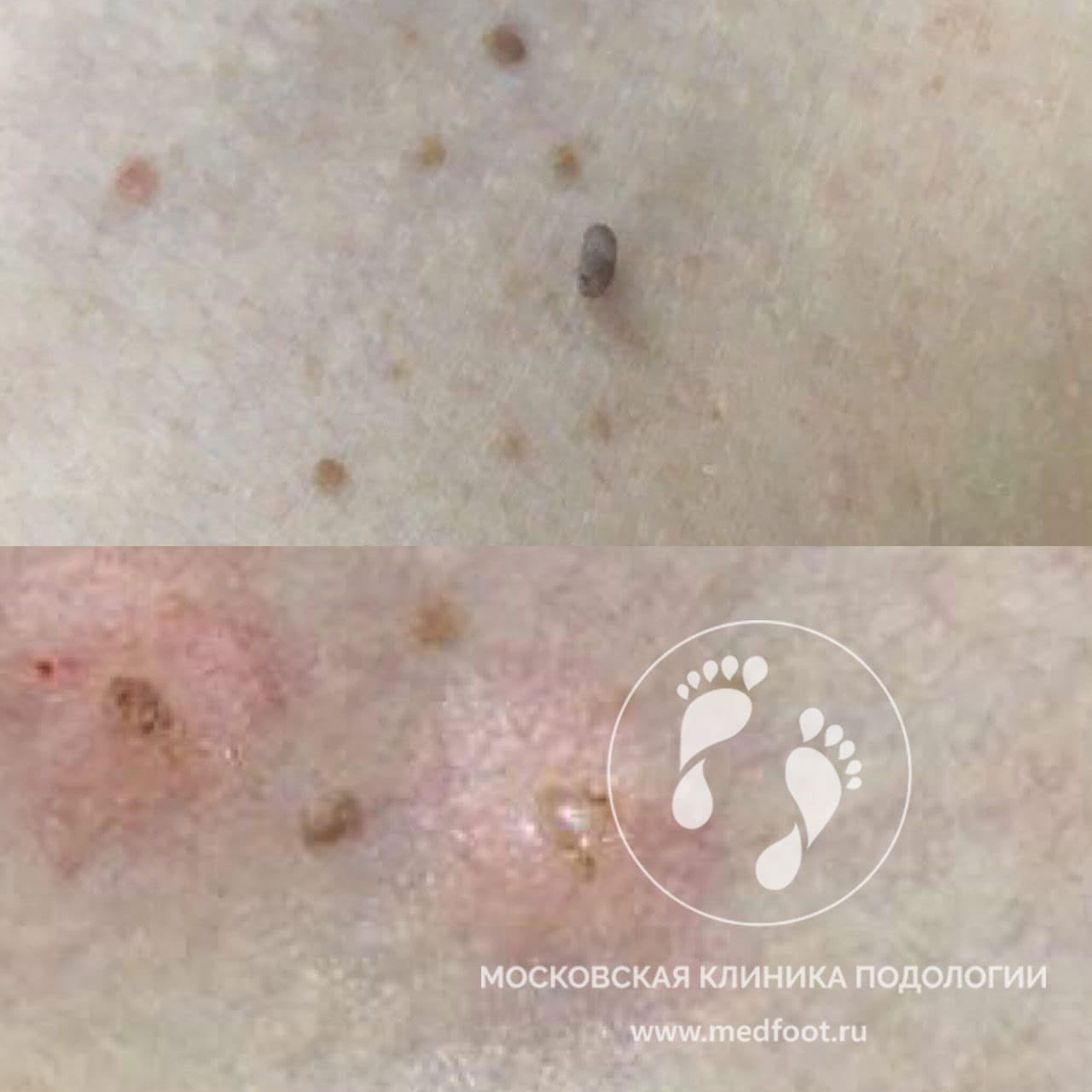 Дерматология. Папилломы на коже. Как лечить?