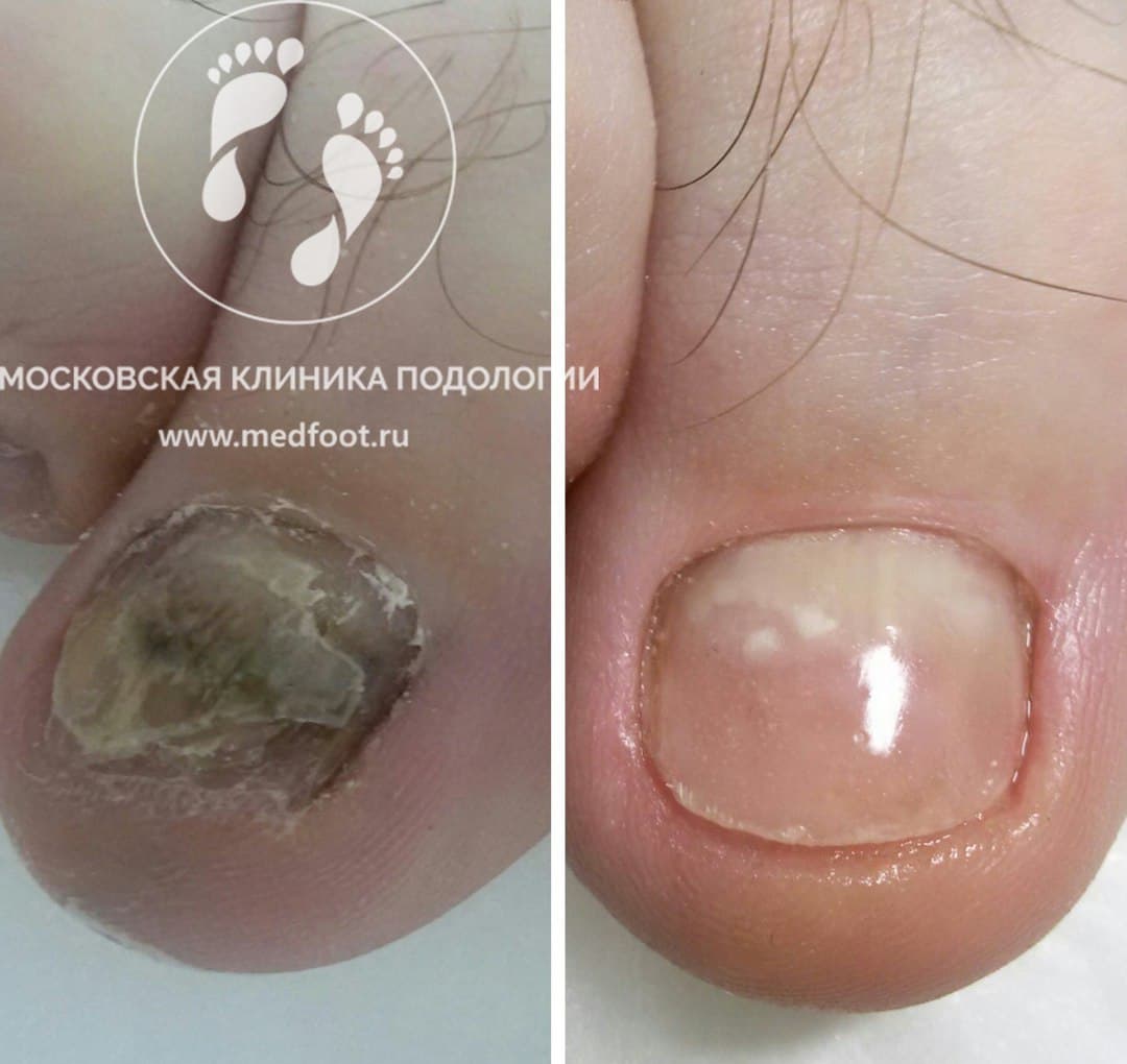 Дистрофия ногтевой пластины
