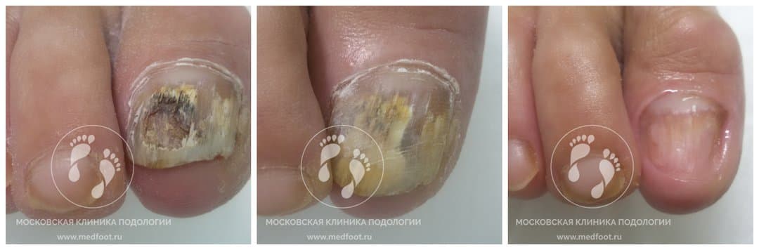 Грибок ногтя