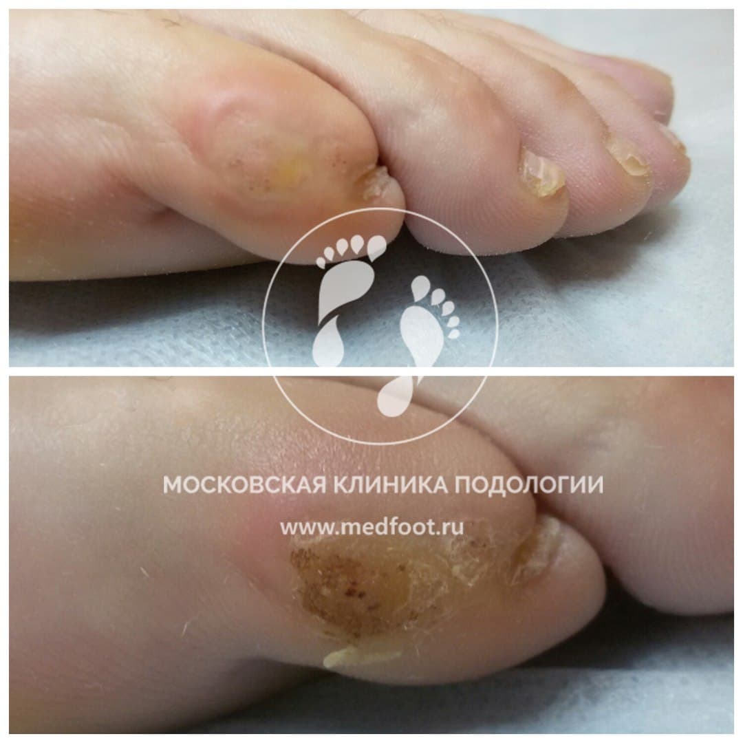 Лечение бородавки