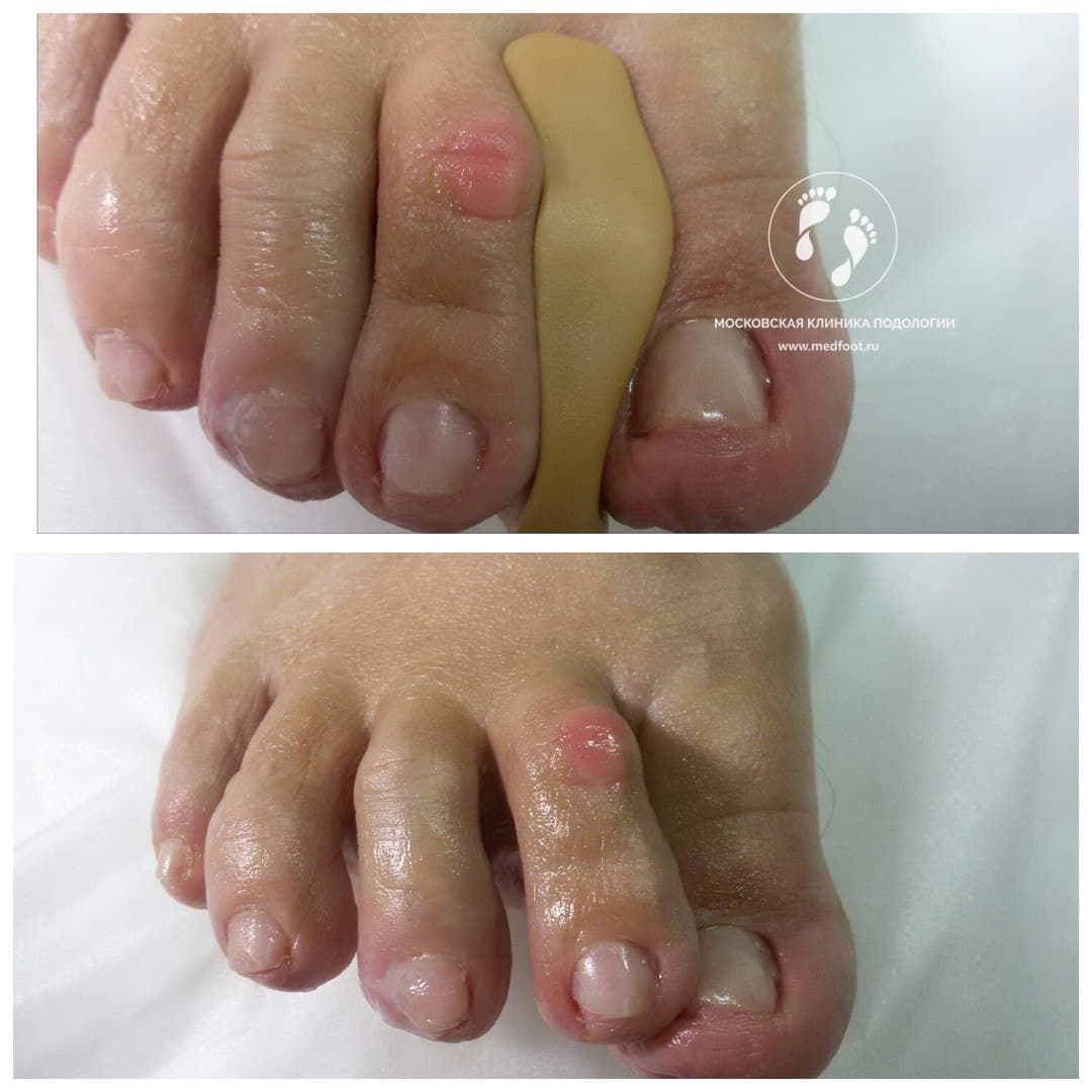 Лечение Hallux Valgus