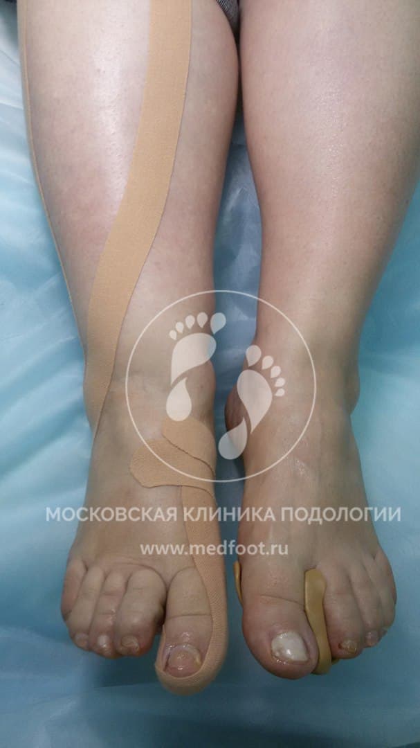 Отек ног, проблема вросшего ногтя