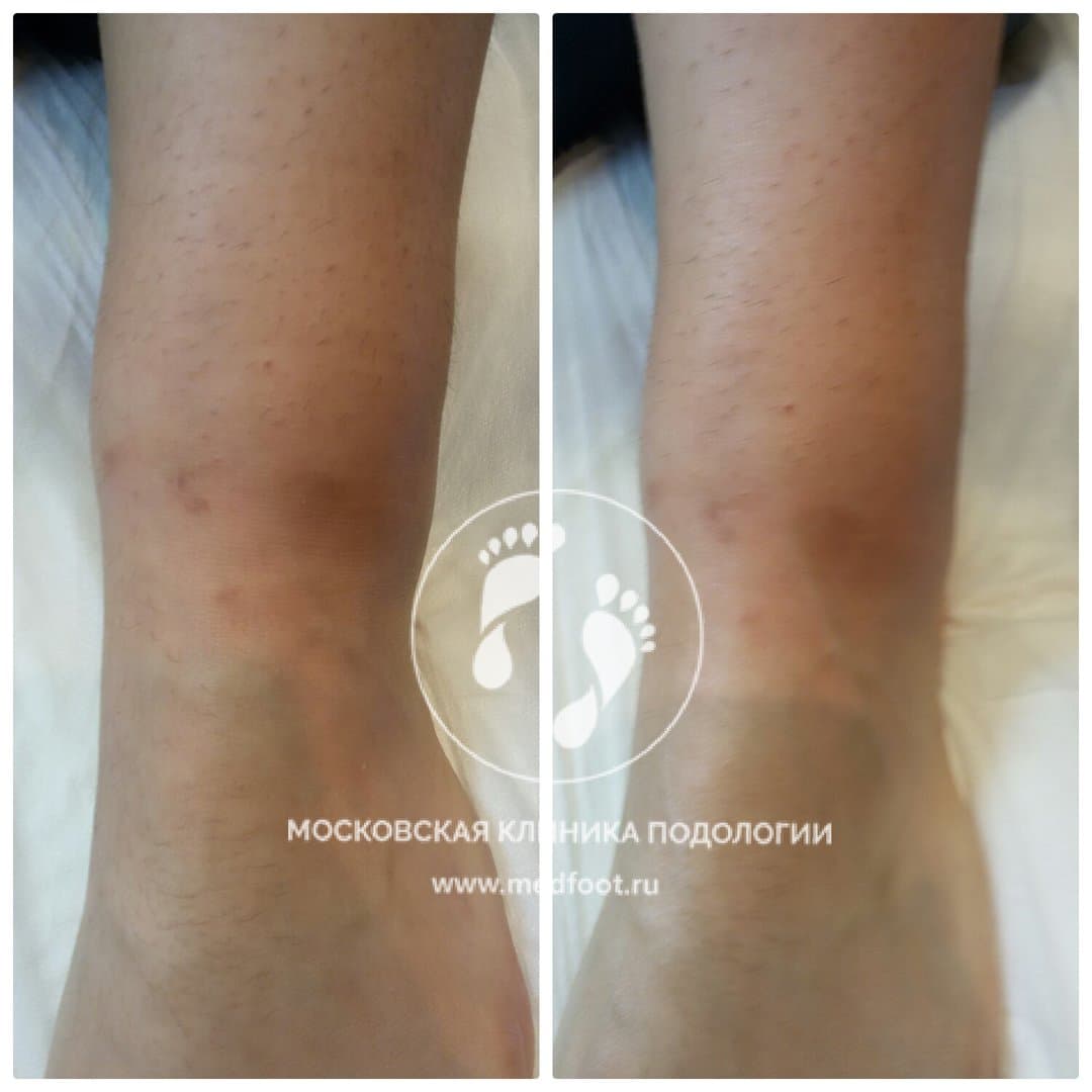 Посттравматическая терапия