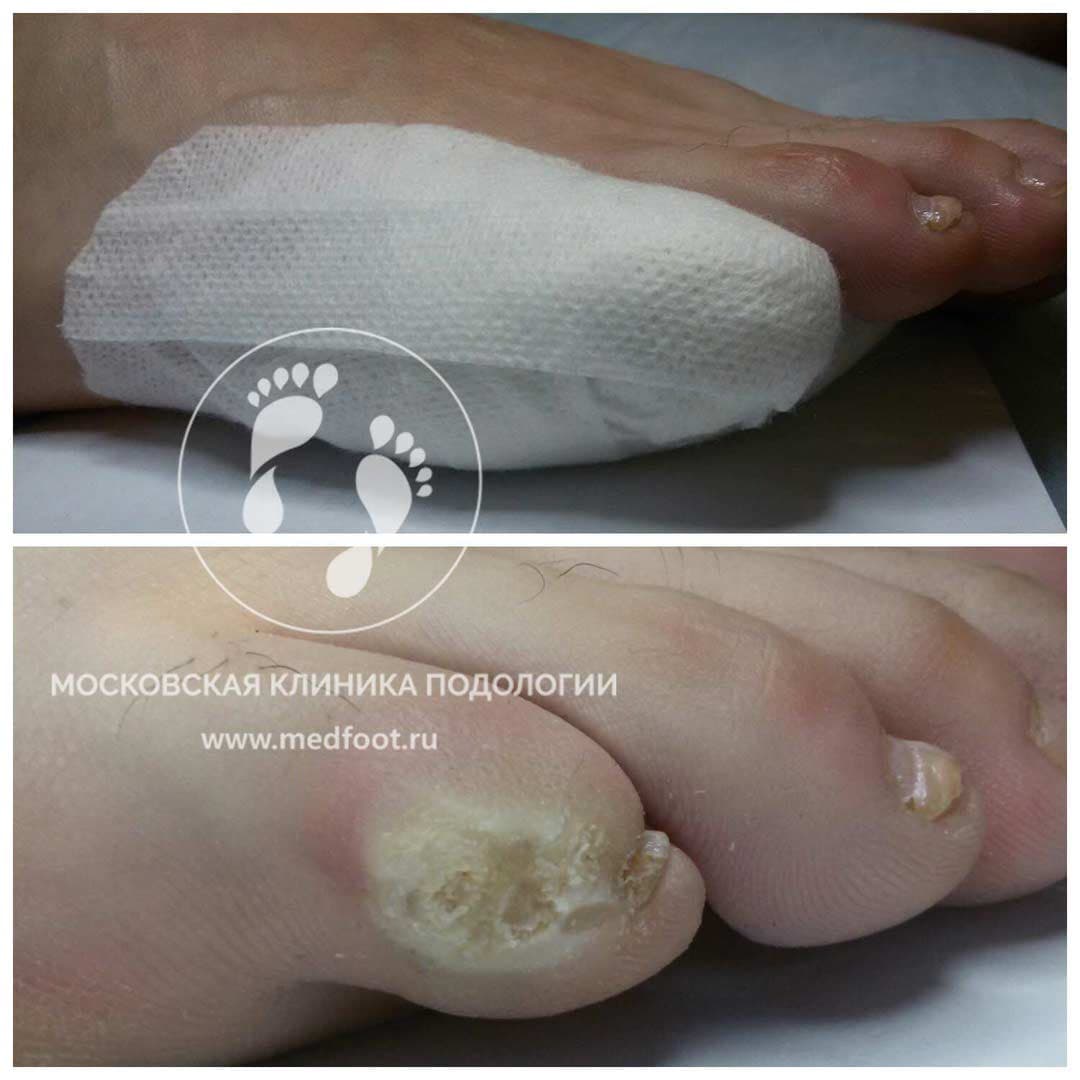 Стержневая мозоль гипергидроз