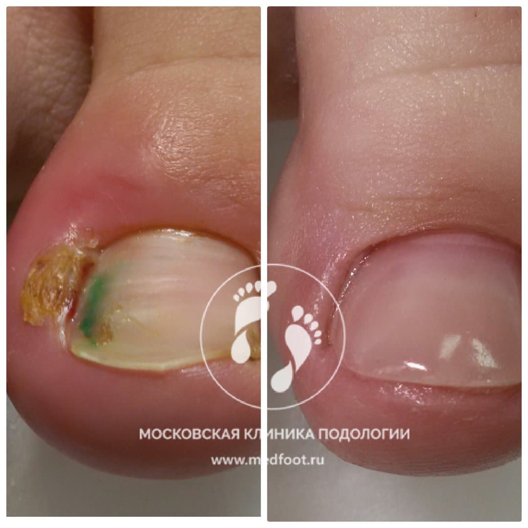 Воспаление и отек мягких тканей