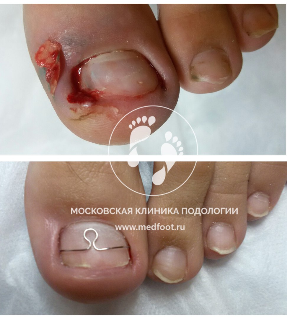 Онихокриптоз (Врастающий ноготь)
