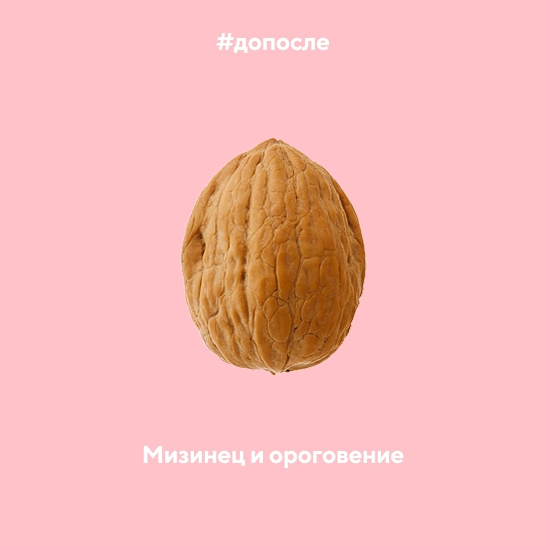 Ороговение на мизинце ноги