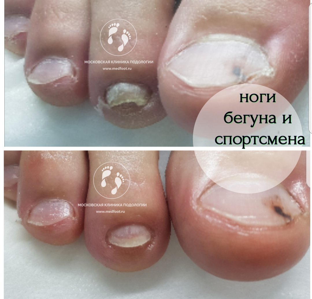 Спорт и Подология